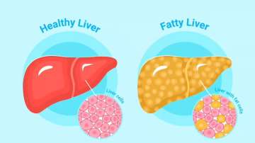 How to enhance healing process fatty liver at home