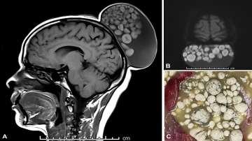 Doctors remove 'sack of marbles' from Bengaluru woman's scalp growing since childhood