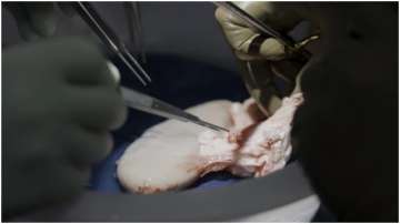 NYU surgeons transplanting a pig kidney in a deceased human's body