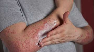 Psoriasis