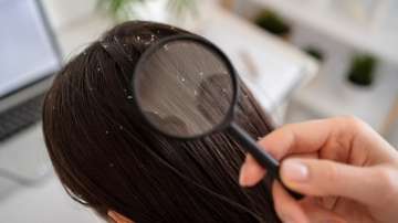 oiling for treatind dandruff