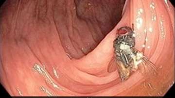 fully intact house fly inside the intestine of a 63-year-old