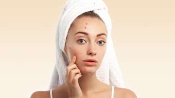 Young woman with towel on head and pimples on face