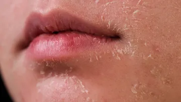 Skin Peeling