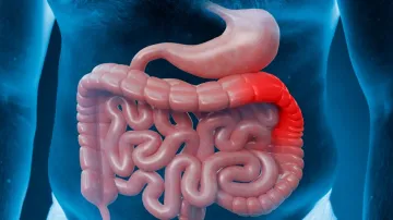 colon cancer