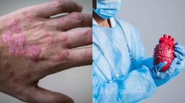 psoriasis and heart diseases