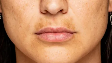 Hyperpigmentation