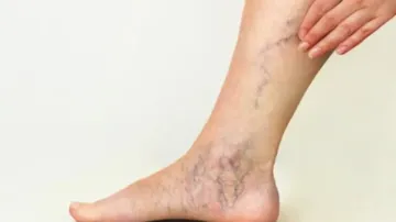 Varicose Veins