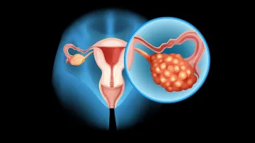 Ovarian cancer