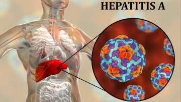 Hepatitis A