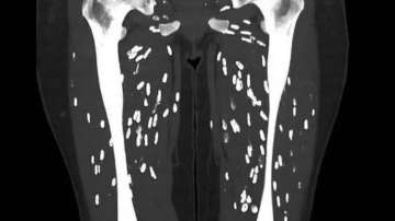 CT scan parasitic infection 