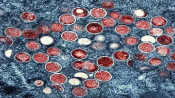 Sweden confirms first case of Mpox virus outside Africa 