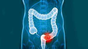 colorectal cancer