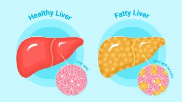 Fatty liver causes several serious health issues