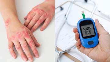 Gangrene spreads rapidly in diabetic patients