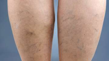 Know causes, symptoms and treatment for varicose veins