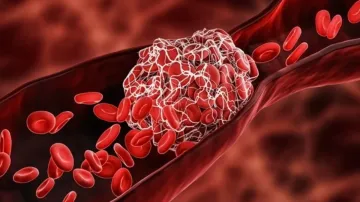 Thrombosis