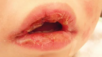 Kawasaki disease