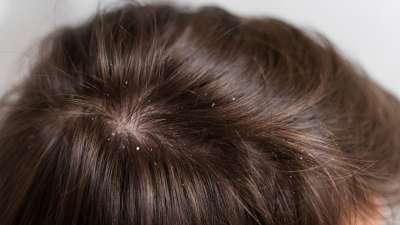 4 Kinds Of Dandruff Identify Which Type Is Causing Your Scalp To Itch   Flake