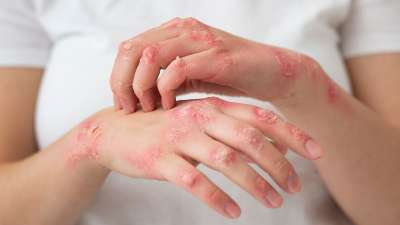 Useful tips for dealing with ringworm this summer – India TV