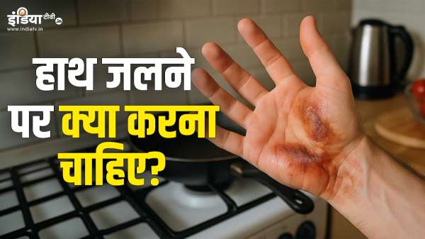 किचन में काम करते हुए जल जाए हाथ, तो झट से सबसे पहले क्या करें, कई लोग कर बैठते हैं गलती