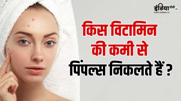 किस-किस विटामिन की कमी से निकलते हैं पिंपल्स, जान लें डेफिशिएंसी को दूर करने का तरीका