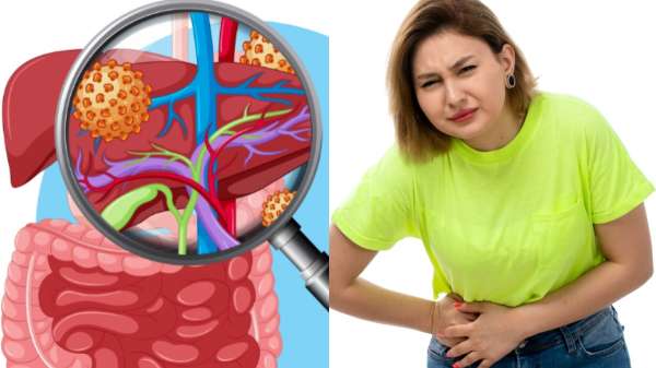 खाने की ऐसी चीजें, जो बन सकती हैं फैटी लिवर का कारण, कहीं आप भी तो नहीं कर रहे हैं सेवन?