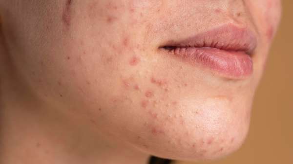 नाश्ते में कैसे बनाएं स्वादिष्ट खिला-खिला पोहा, नोट कर लीजिए रेसिपी, पोषक तत्वों से भरपूर है टेस्टी डिश