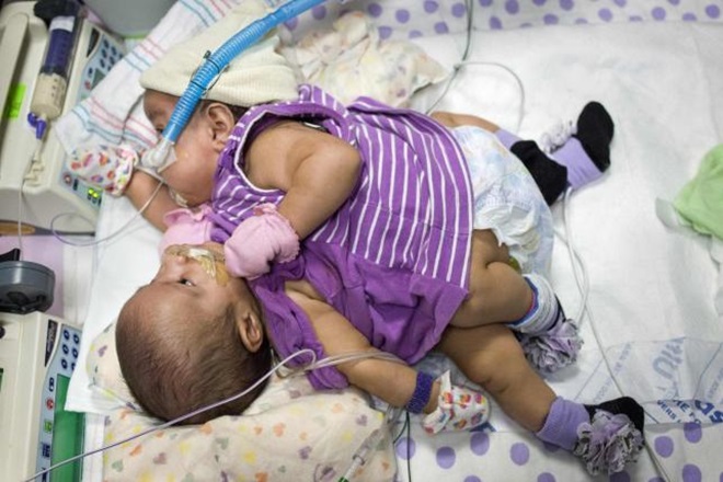 Woman Gives Birth To Rare Conjoined Twins With Common Heart In Mumbai India News India Tv