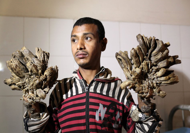 Bangladeshi Tree Man Successfully Operated of Condition That Turned His