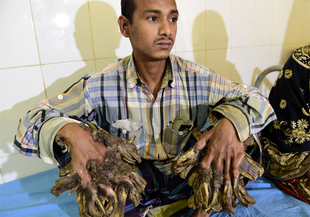 Bangladeshi Tree Man Successfully Operated of Condition That Turned His