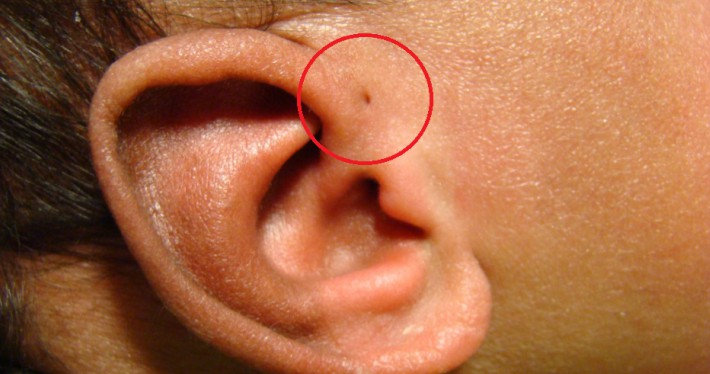Have you seen someone with a 'Tiny Hole' above their ears? This is what it  means | People News – India TV
