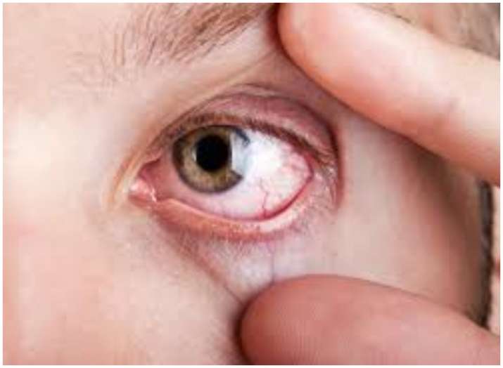 Chronic dry eye disease may slow down your reading speed,