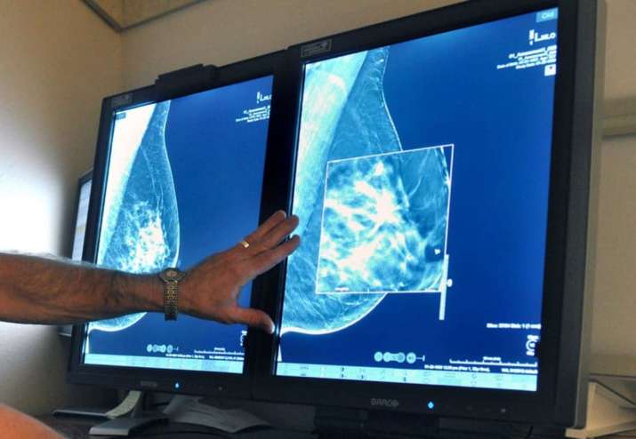 New artificial intelligence model can predict future risk of breast cancer  | Science News – India TV