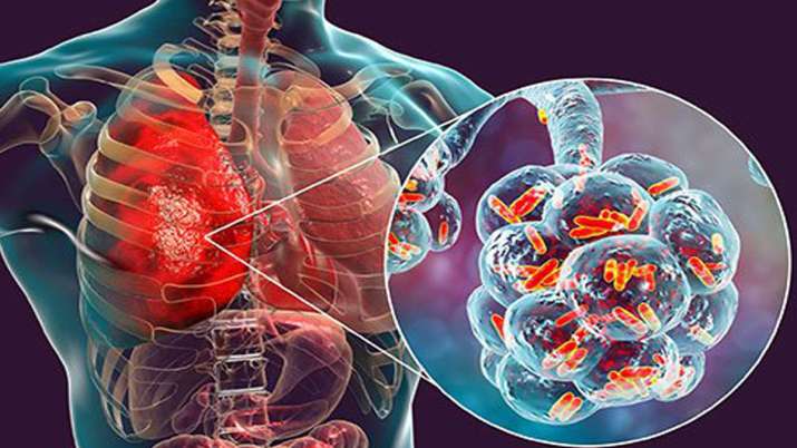 India saw 2nd-highest number of pneumonia deaths of