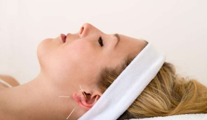 acupuncture, migraine