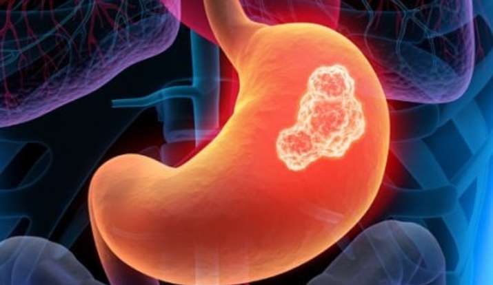 Stomach disorders