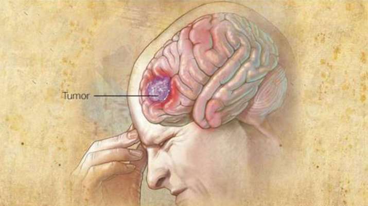 On World Brain Tumour Day Know Why Patients Must Not Delay Taking Covid Vaccine On News India Tv