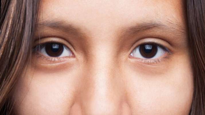 Watch out for these signs for glaucoma risk in children - Vimarsana News
