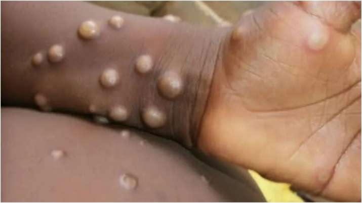 Belgium becomes world’s first nation to mandate 21-day quarantine for Monkeypox