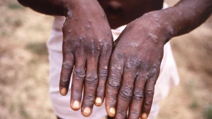 Pedoman baru kementerian kesehatan virus Monkeypox menekankan pada identifikasi cepat kasus NIV Pune