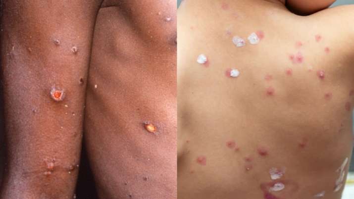 Is monkeypox similar to smallpox or more dangerous? Know Symptoms, signs and prevention - Vimarsana News