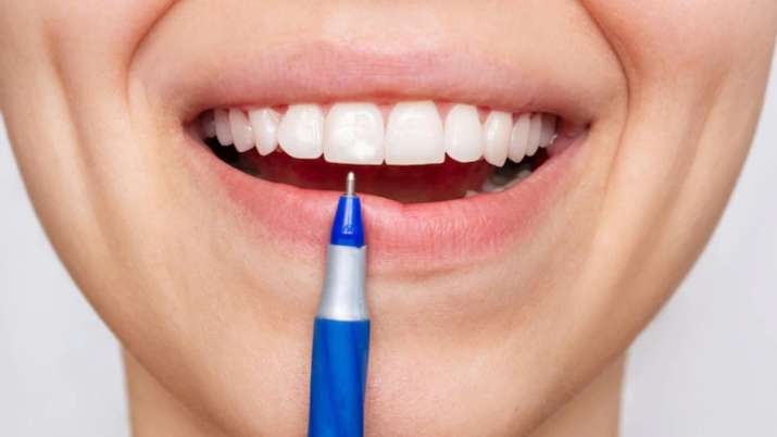 White spots on teeth here are causes and remedies | White News – India TV - Vimarsana News