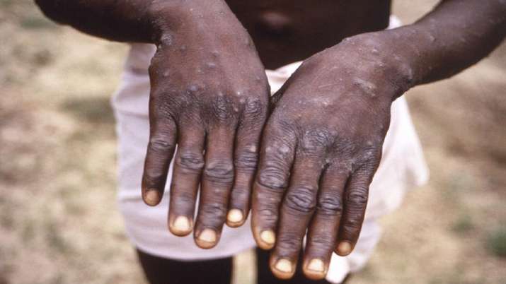 WHO will share vaccines to prevent monkeypox amid fears of inequality, WHO News, cases of monkeypox, monkeypox vi