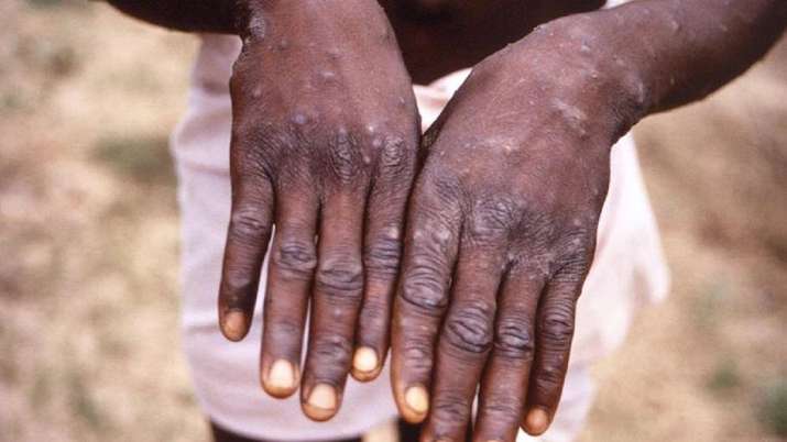 Kerala: SOPs issued for isolation, sample collection, treatment of monkeypox cases - Vimarsana News