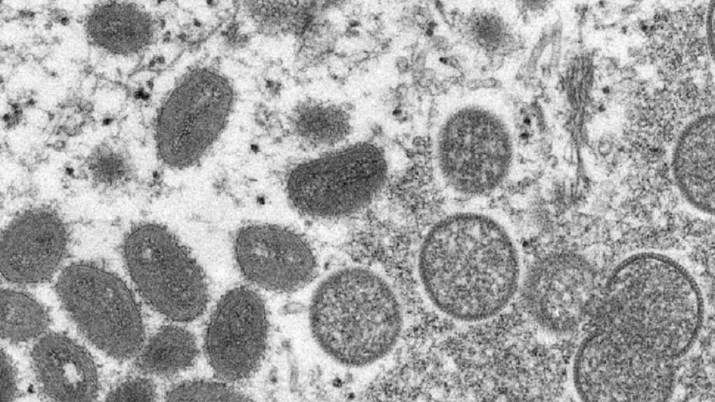 Monkeypox can spread from close physical contact regardless of sexual orientation, race: Experts - Vimarsana News
