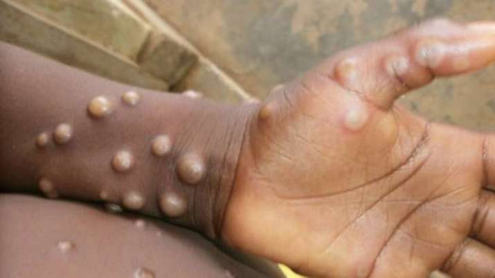 Serious! Monkeypox virus can persist in semen for weeks after recovery, claims Lancet - Vimarsana News