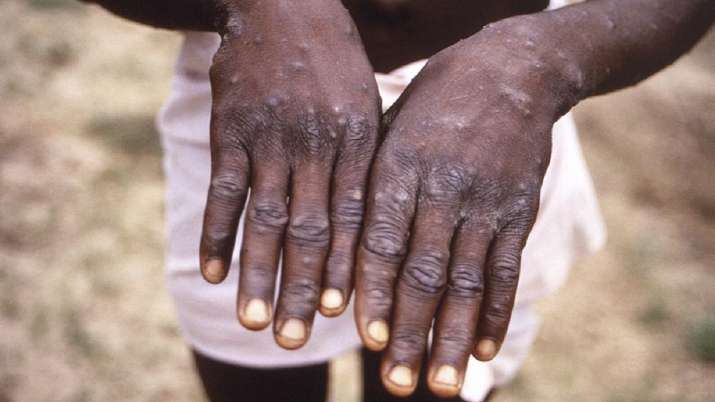 Monkeypox: Kerala confirms state's 5th case of virus in 30-year-old from UAE - Vimarsana News