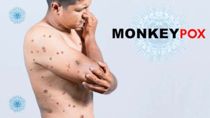 Monkeypox outbreak: Is it still possible to control it? Here's what Ex-FDA chief has to say - Vimarsana News