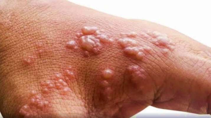 Monkeypox Outbreak: Asymptomatic infection can be a cause of concern, reveals study - Vimarsana News